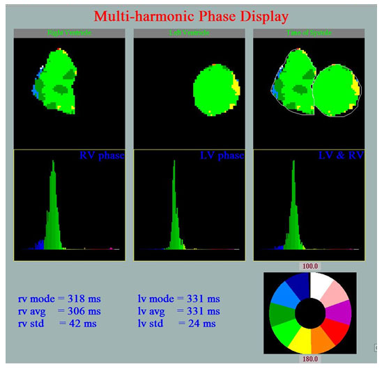 Εικόνες φάσεως των κοιλών της καρδιάς που δείχνουν τον συνχρονισμό της συστολής Εικόνες φάσεως των κοιλών της καρδιάς που δείχνουν τον συνχρονισμό της συστολής