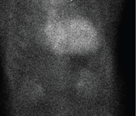 Θετικό σπινθηρογράφημα για αμυλοείδωση από τρανσθυρετίνη Θετικό σπινθηρογράφημα για αμυλοείδωση από τρανσθυρετίνη